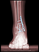 'Tri-Malleolar Fracture & Fixation,X-Ray