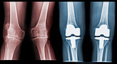 Bilateral Total Knee Replacement (Pre & P