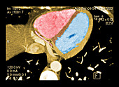 Cardiac CT Angiography