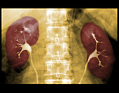 IVP of Normal Kidneys