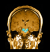 MRI Brainstem Cavernous Malformations