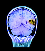 MRI of Brain AVM