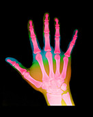 X-Ray of a Hand