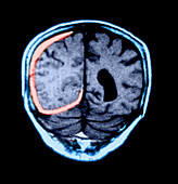 MRI of Head Trauma