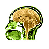 Sagittal View of an MRI of the Brain