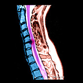 Herniated Disc in Cervical Spine