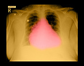 Enlarged Heart on Chest X-ray