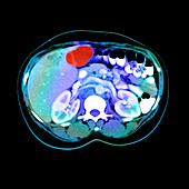 CT Scan of a Liver Tumor