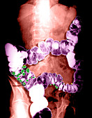 Barium Enema Showing Diverticulosis