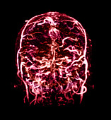 MRI of Venogram of Dural Sinus Thrombosis