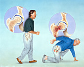 Osteoporosis and Hip Fracture