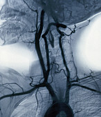 Angiogram of Carotid Arteries