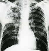 Tuberculosis,X-Ray