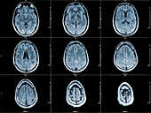 Axial Brain MRI