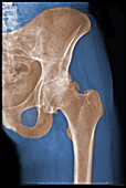 Osteoarthritis,Hip