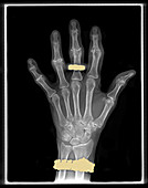 Osteoarthritis,Hand