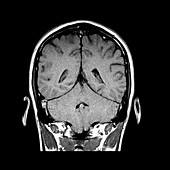 MRI of Chiari I Malformation,2 of 2