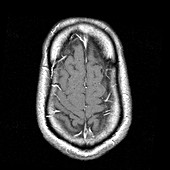 MRI of Dolichocephaly
