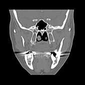 CT of Skull Base Foramina