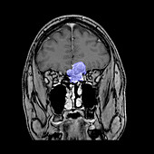 MRI of Esthesioneuroblastoma
