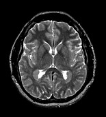 MRI of Heterotopic Gray Matter