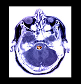 Cavernous Malformation,MRI