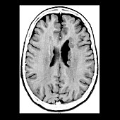 Heterotopic Gray Matter,MRI