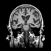 MRI of Alzheimers Disease