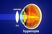 Correction of Hyperopia Diagram