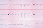Third Degree AV Block EKG