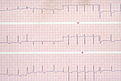 Atrial Fibrillation EKG