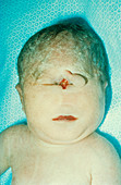 Trisomy 13,Stillborn Infant