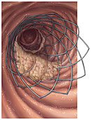 Duodenal Stent