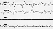 Polygraph Tracings of REM Sleep