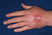 MRSA Hand Infection