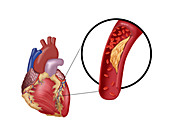 Atherosclerotic Coronary Artery Disease