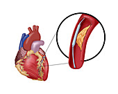 Balloon Angioplasty,1 of 4