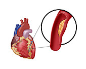 Balloon Angioplasty,3 of 4