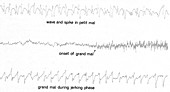 EEG of Epileptic Seizures