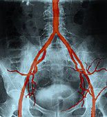 Normal Arteriogram