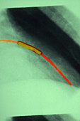 Narrowing in Coronary Artery (2 of 3)