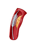 Angioplasty with Stenting,2 of 4