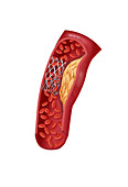 Angioplasty with Stenting,4 of 4