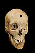 Bullet hole in skull