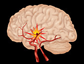 Brain Aneurysm,3 of 3