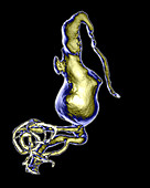 Basilar Artery Aneurysm,3D Scan