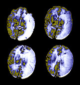Large Infantile Stroke,MRI