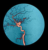 Internal Carotid Artery,Angiogram