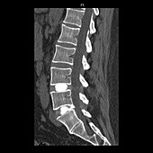 Spinal Disc Herniation,CT