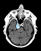 Skull Base Meningioma,MRI